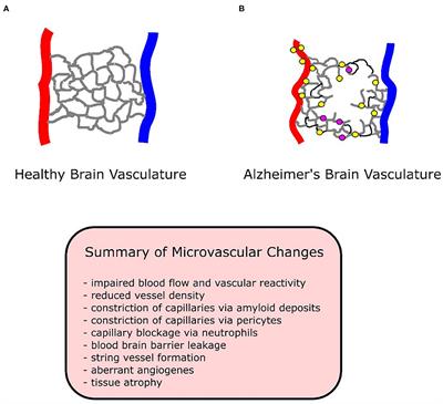 Microvascular Alterations in Alzheimer's Disease